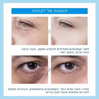 סרום להעלמת קמטים